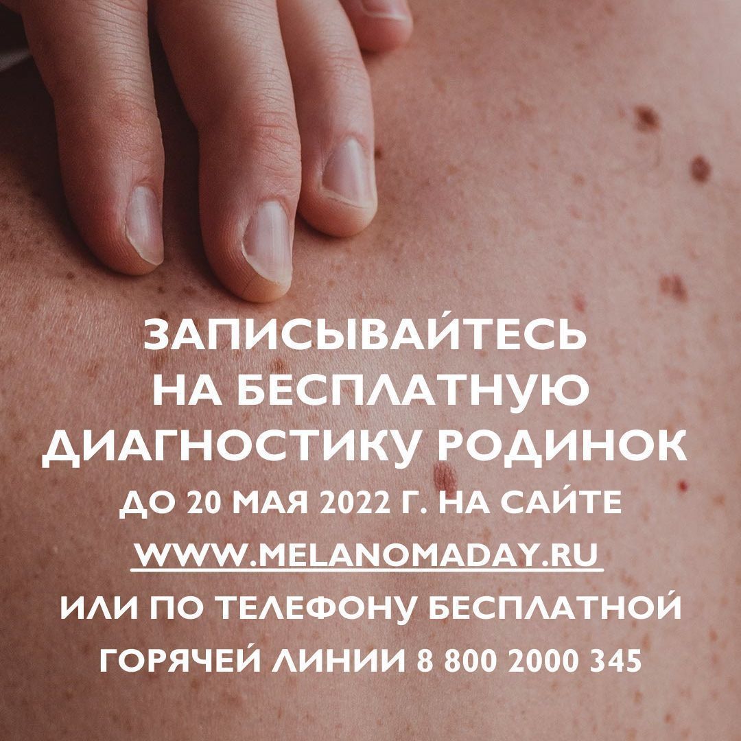 23 мая в клинике "Тринити" пройдет "день Меланомы", прием бесплатный