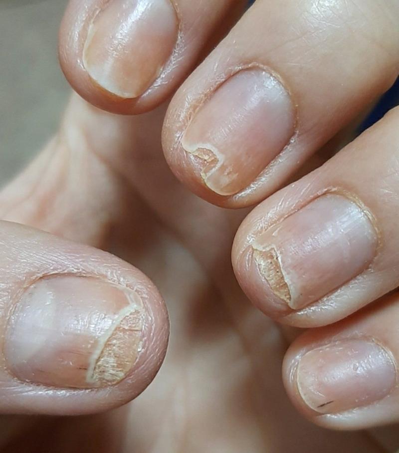 Как вылечить ногтевой грибок? — Семейная Консультация