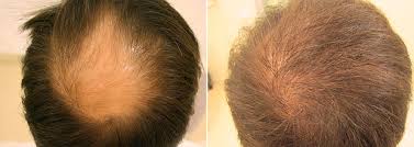 Плазмотерапия для волос