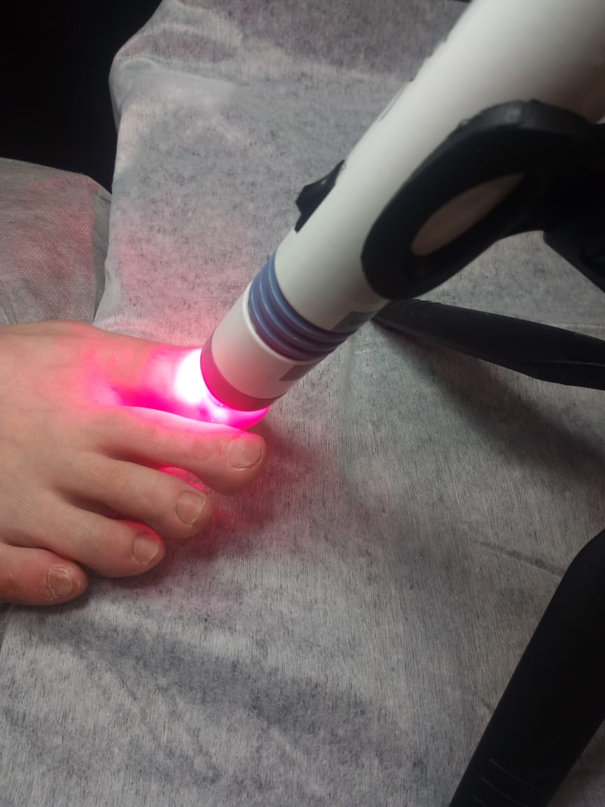 изображение Фотодинамическая терапия ногтя - Клиника ТРИНИТИ - Москва м.Белорусская