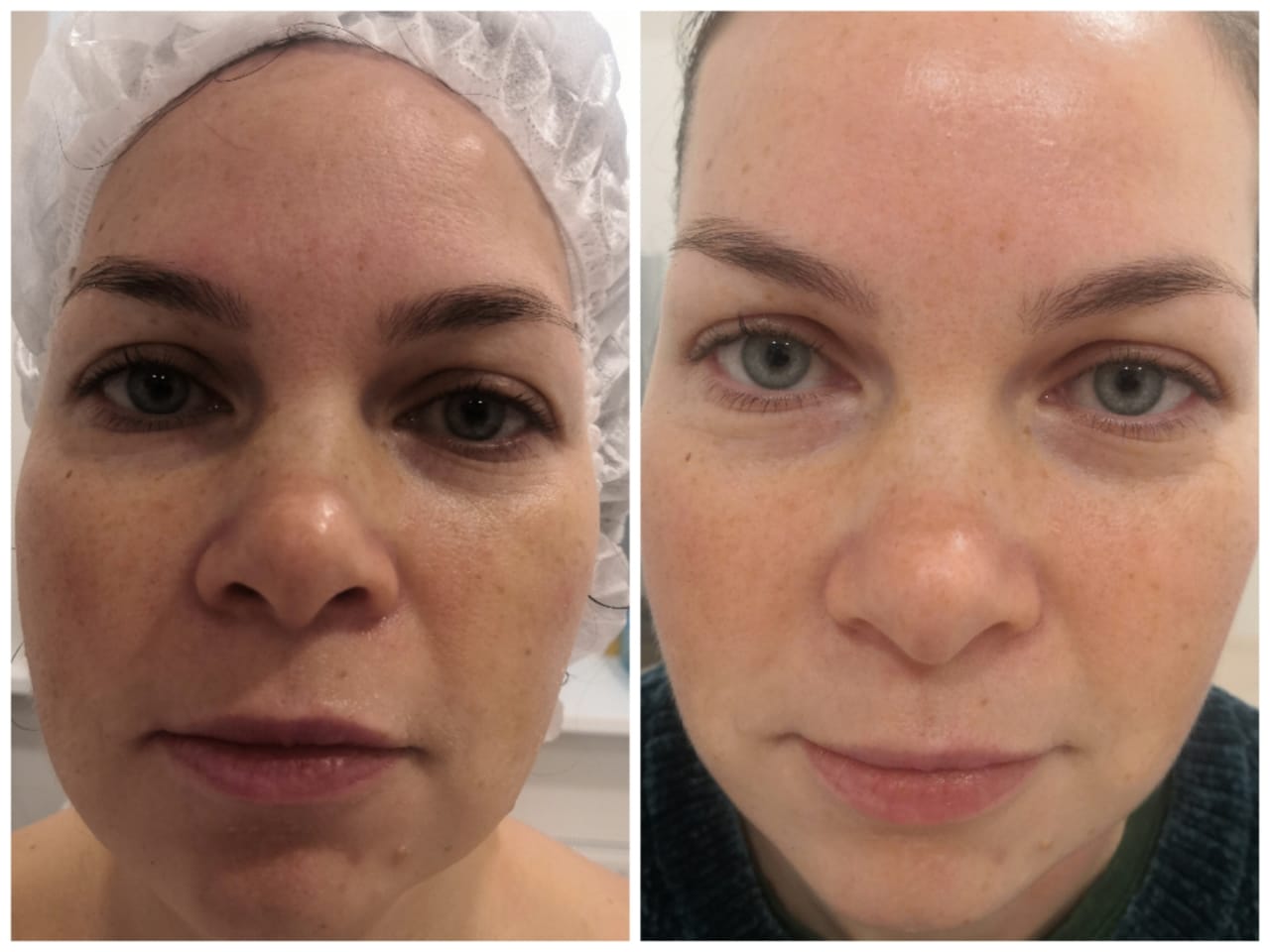 фото до и после криотерапии лица