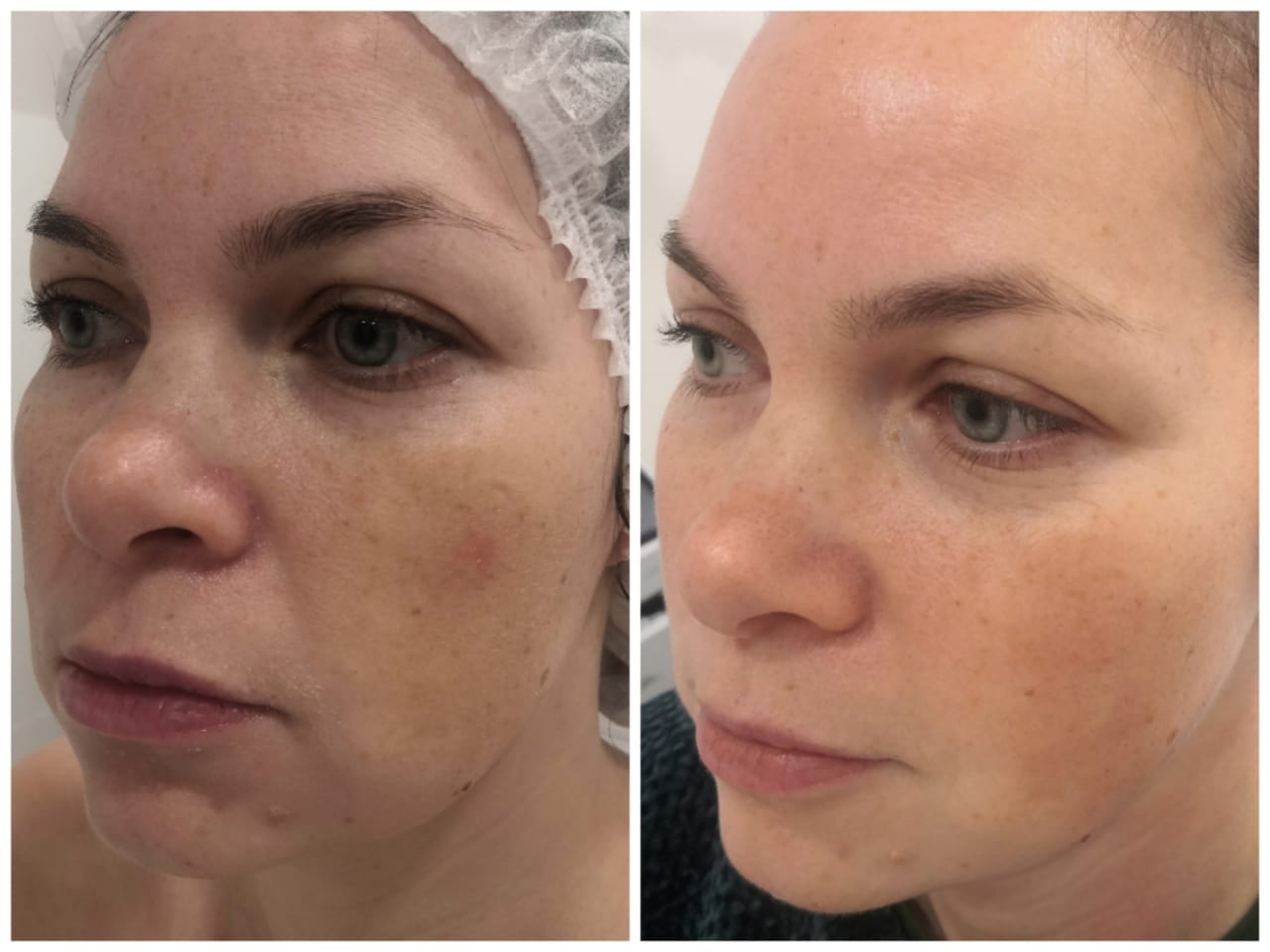 изображение до и после криотерапии лица