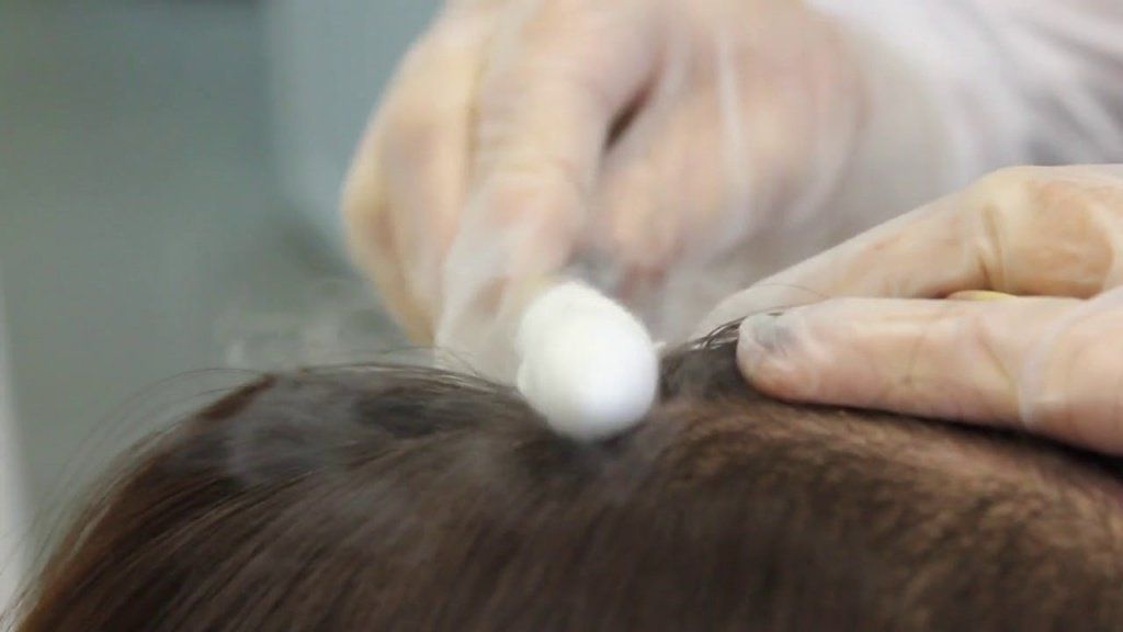 изображение Криотерапия для волос - Клиника ТРИНИТИ - Москва м.Белорусская