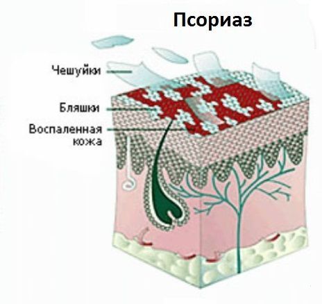 изображение Лечение псориаза - Клиника ТРИНИТИ - Москва м.Белорусская